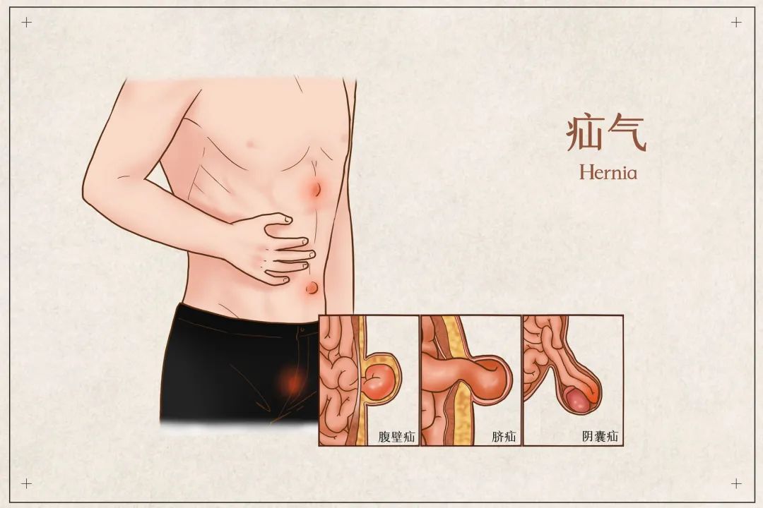 這樣的“包”不能要——廣濟普外科巧治罕見“疝”